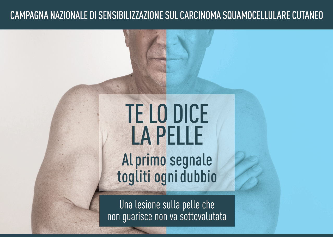 Clicca per accedere all'articolo Campagna nazionale sul carcinoma squamocellulare - AOU Senese 